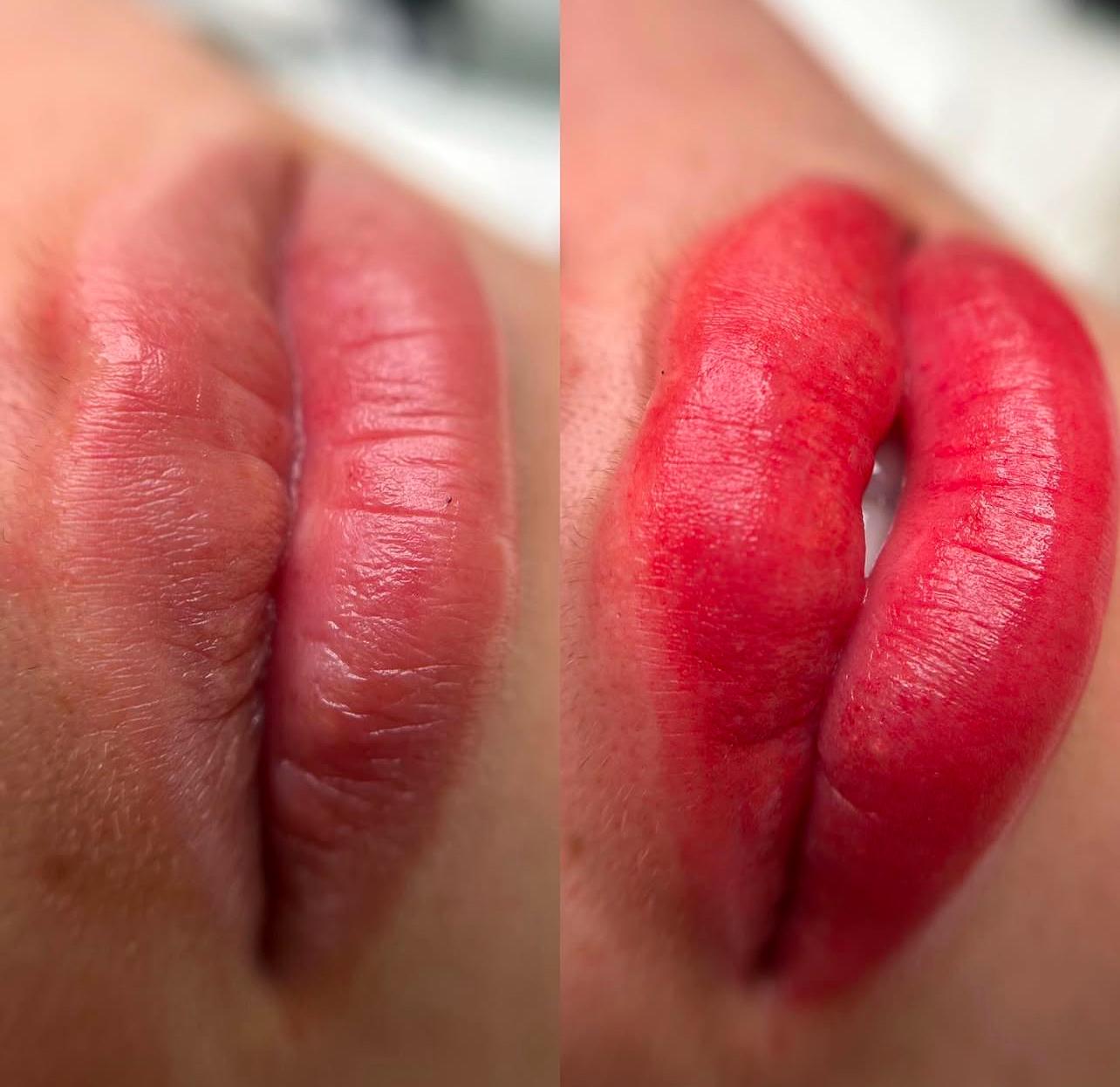 Microneedling Ergebnis – Hautverjüngung in Nidda